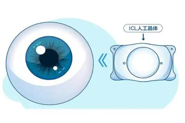 ICL晶体植入度数范围：一般是近视50度至1800度、散光600度以内，要求是近2年度数稳定！