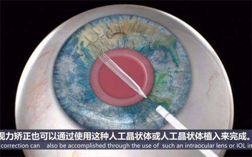 晋江梅岭艾仕瞳眼科怎么样正规吗？有正规资质,技术可靠价格也合理!附详细地址！