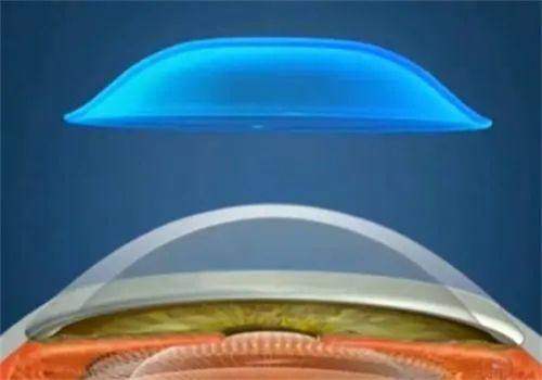 二、福州东南眼科医院近视手术成效怎么样？chike.jingansicbd.com